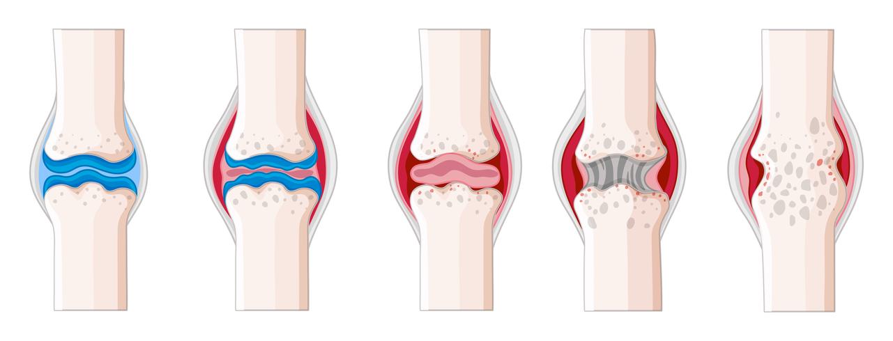 La artritis reumatoide en el cuerpo humano vector