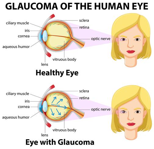 Glaucoma of the human eye vector