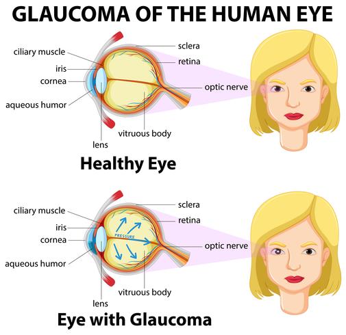 Glaucoma del ojo humano vector