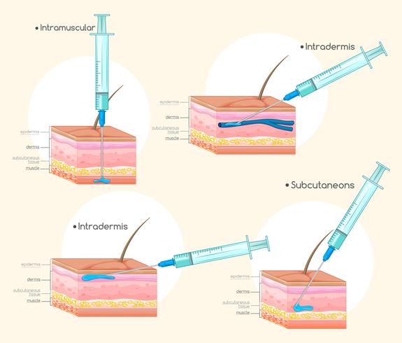 Diferentes tipos de inyecciones. vector