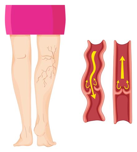 Varicose veins in human leg	  vector