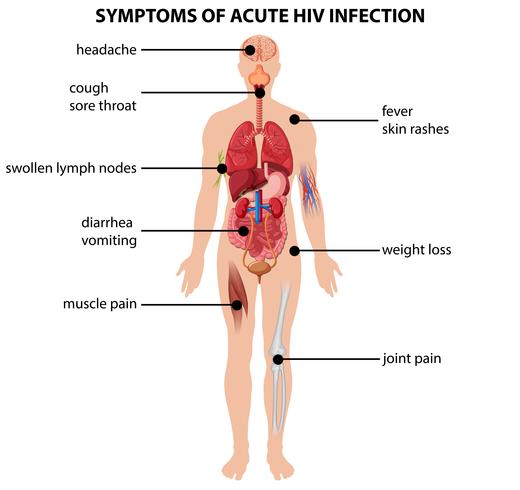 Diagrama que muestra los síntomas de la infección aguda por VIH. vector