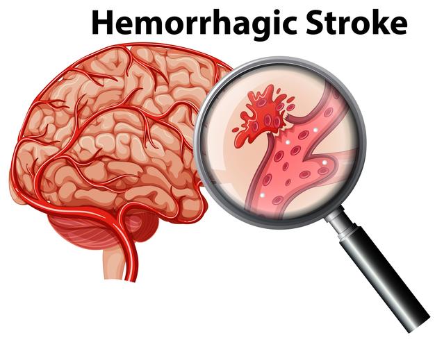 Una anatomía humana del ictus hemorrágico. vector