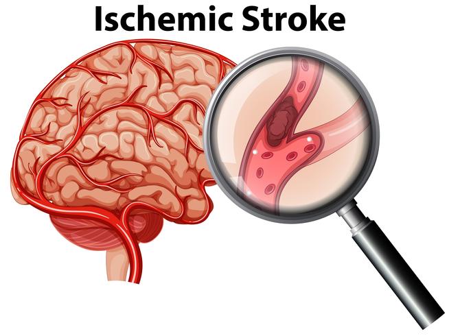 Magnified Ischemic stroke concept vector