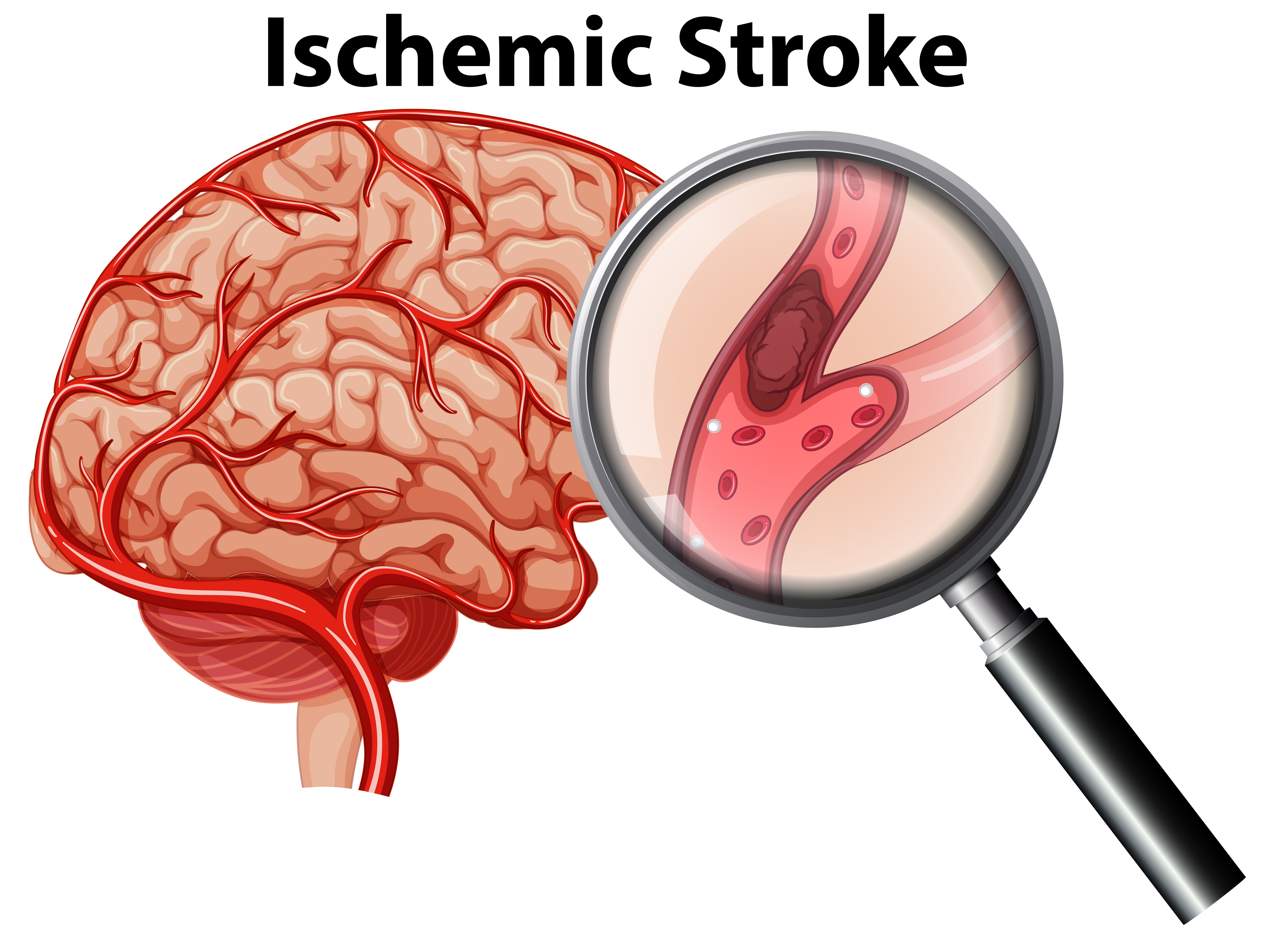 Ischemic Stroke Vector Art, Icons, and Graphics for Free Download