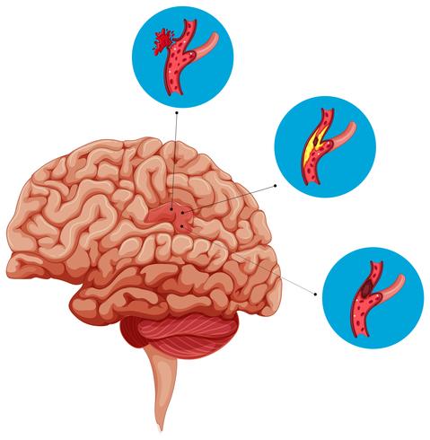 Diagrama que muestra problemas con el cerebro. vector