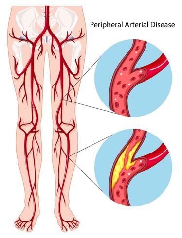 Diagrama de enfermedad arterial periférica vector