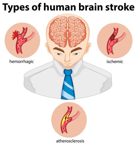 Types of human brian stroke vector