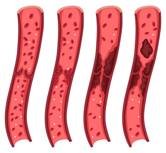 Blood clot diagram on white vector