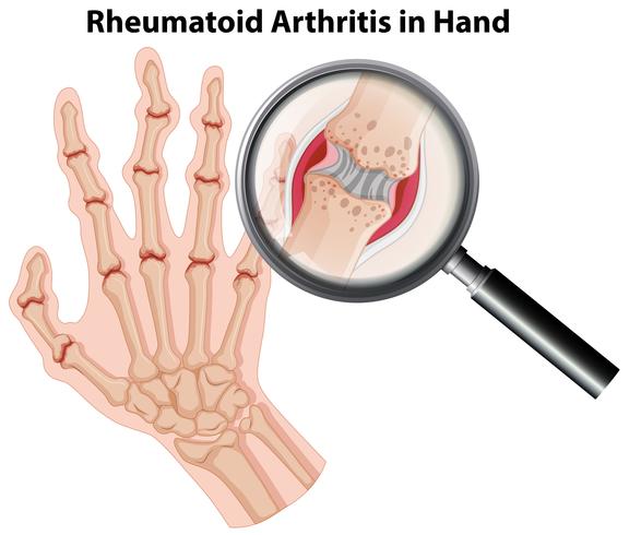 Anatomía humana artritis reumatoide en la mano. vector