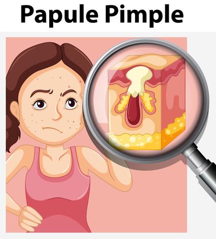 A Papule Pimple on Teenager Face vector