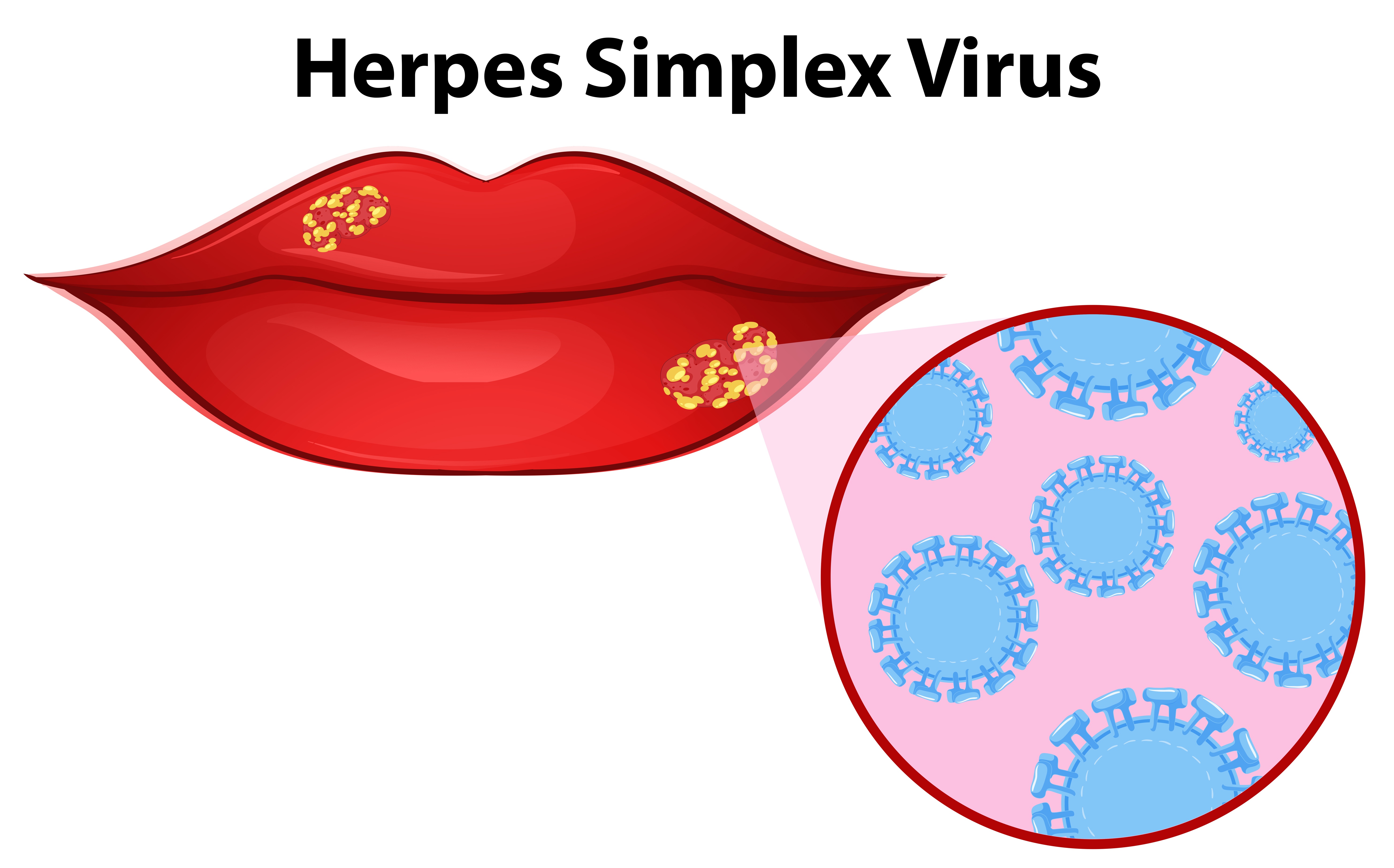 Download the Diagram showing herpes simplex virus 418753