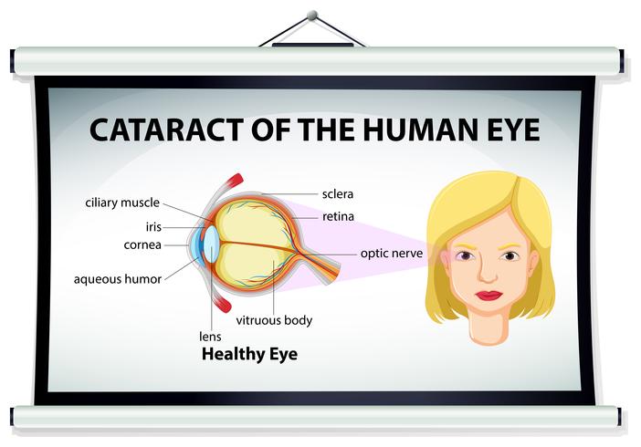 Diagrama de catarata en ojo humano. vector