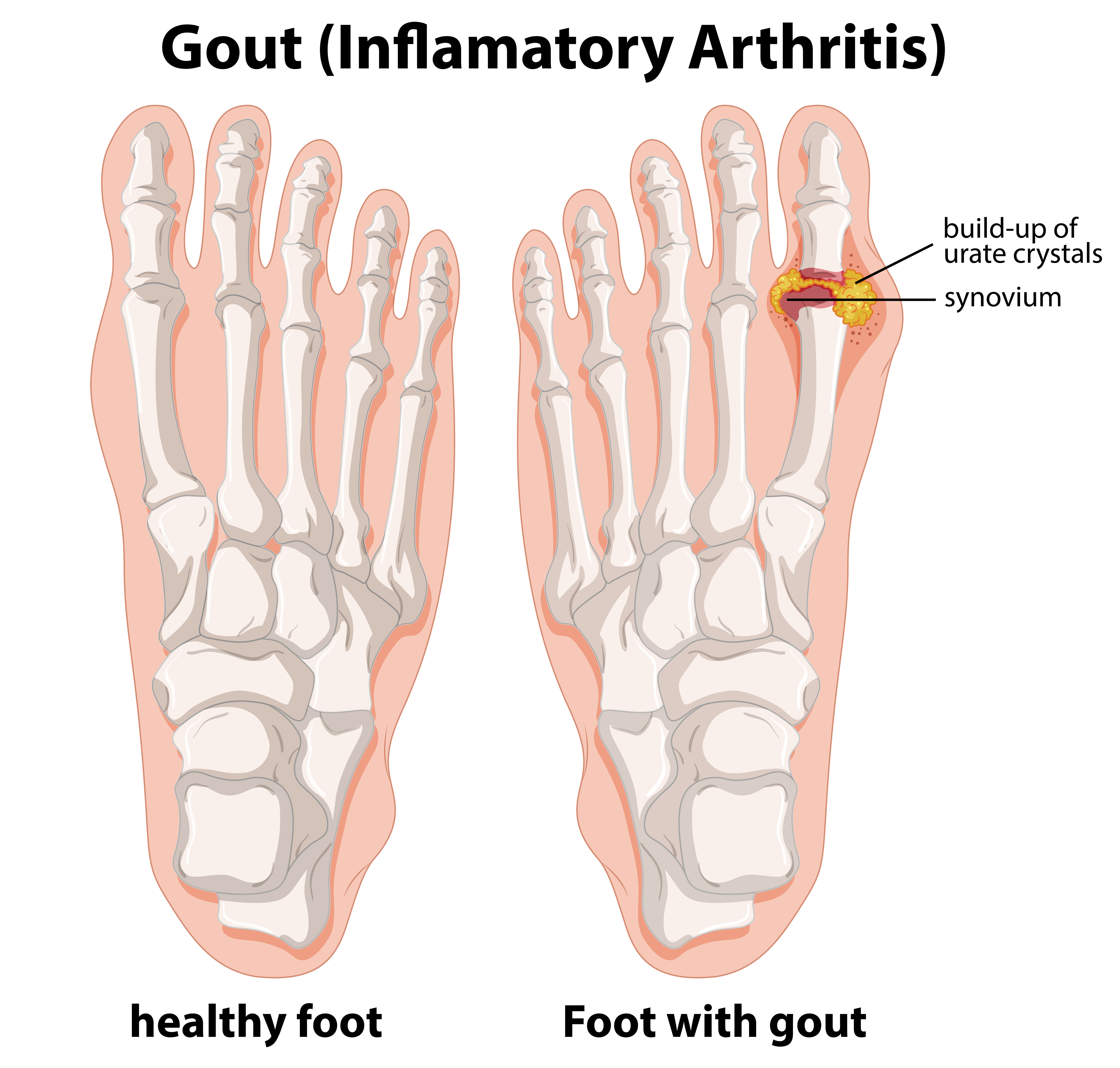 Diagram explanation of Gout in human foot 419346 Vector Art at Vecteezy