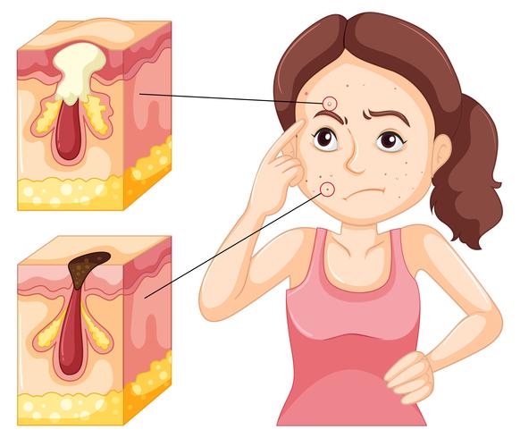 Woman having problem with pimples vector