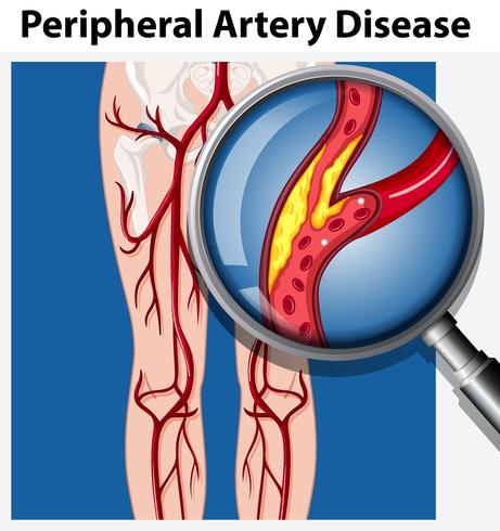 Humano con enfermedad arterial periférica vector