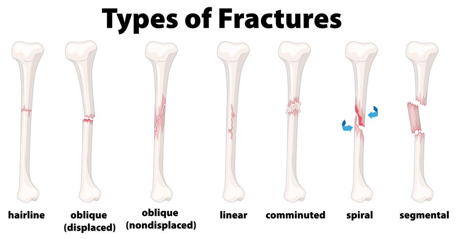 Un conjunto de fracturas óseas vector
