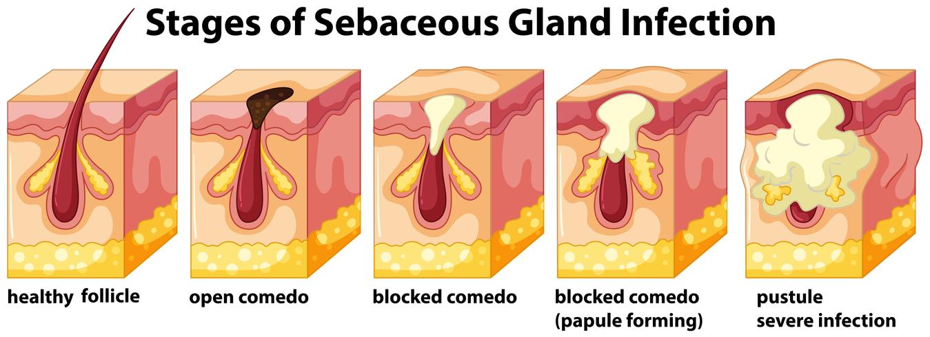 Etapas de la infección de la glándula sebácea vector