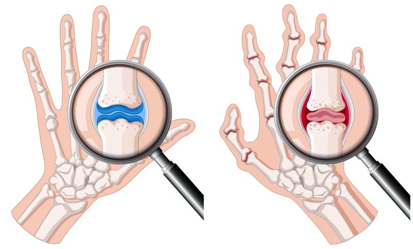 Una mano humana con artritis reumatoide. vector