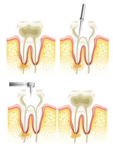 Root canal process vector