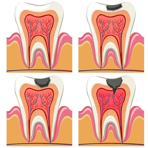 Tooth decay diagram in details vector