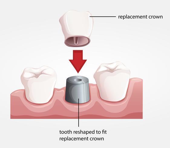 Dental crown procedure vector