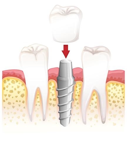 Dental crown procedure vector