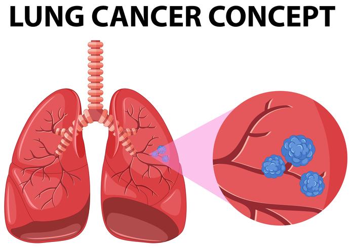 Diagrama del concepto de cáncer de pulmón vector