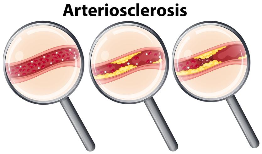 Human with Arteriosclerosis magnified vector