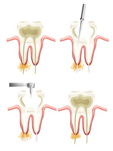 Root canal procedure vector