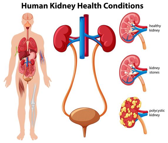 Human Kidney Health Conditions vector