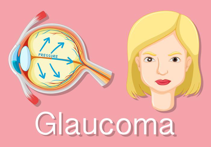 Diagram showing eyes with glaucoma vector