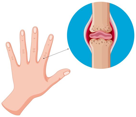 Human hand and bad joints, arthritis vector