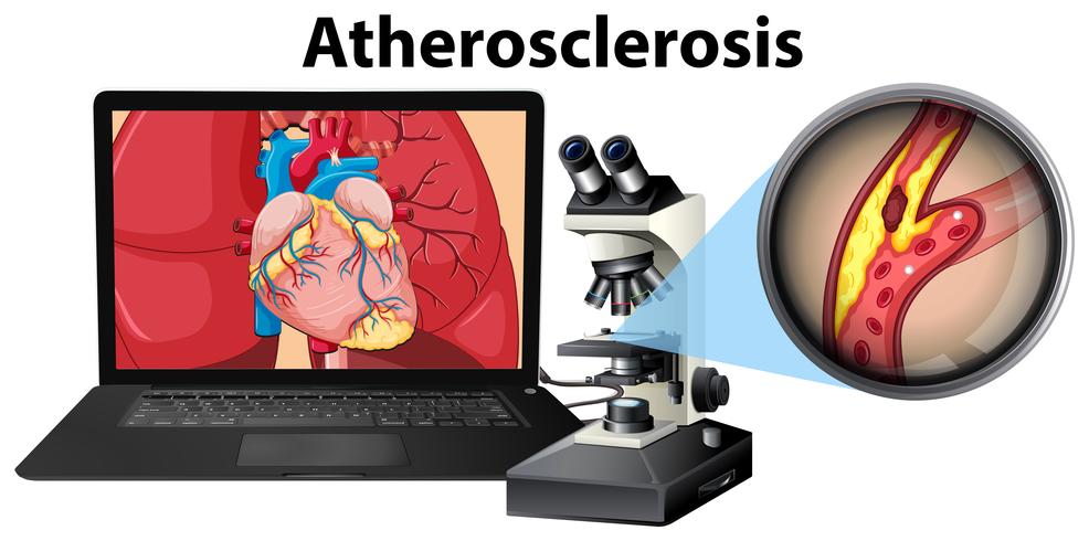 Atherosclerosis laptop and microscope concept vector