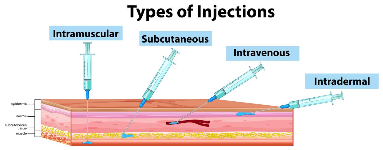 Types of Injections diagram vector