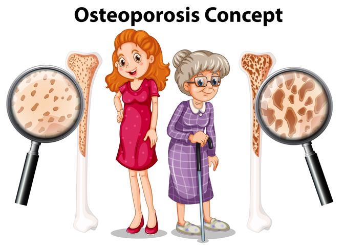 Concepto de osteoporosis en el fondo blanco vector