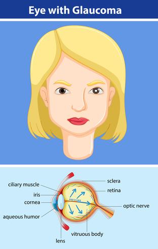 Diagram showing eye with glaucoma vector