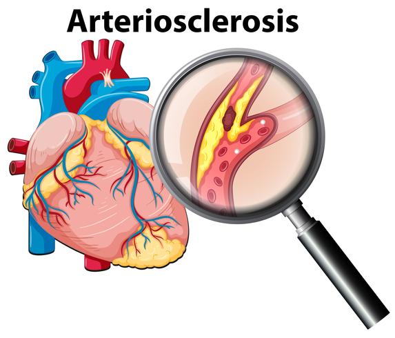 Corazón humano y arteriosclerosis. vector