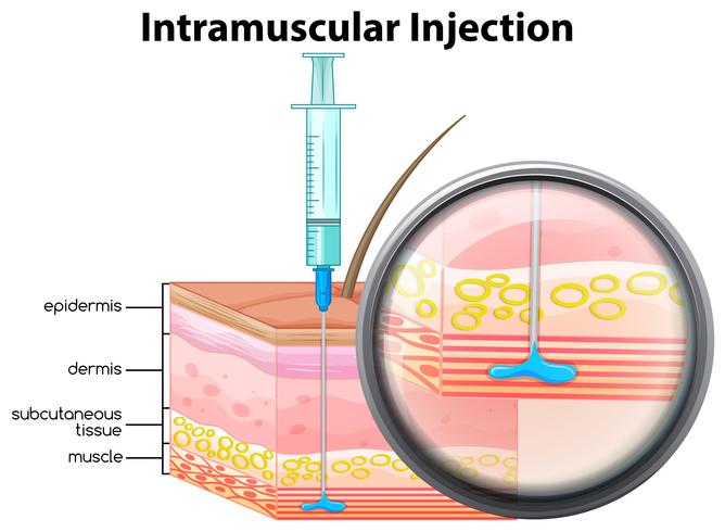 Piel humana inyección intramuscular vector