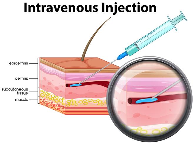 Inyección intravenosa sobre fondo blanco vector