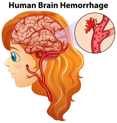 Diagram showing human brain hemorrhage vector