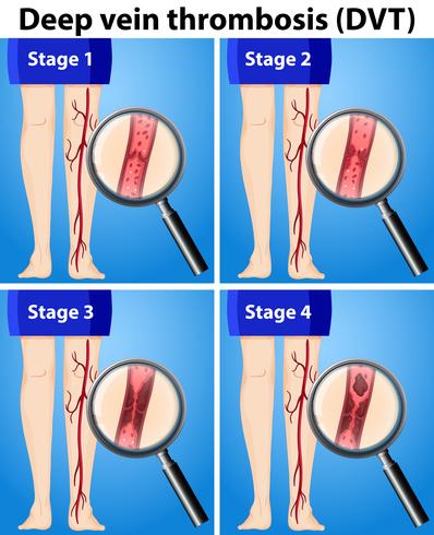 Four Stages of Deep Vein Thrombosis vector