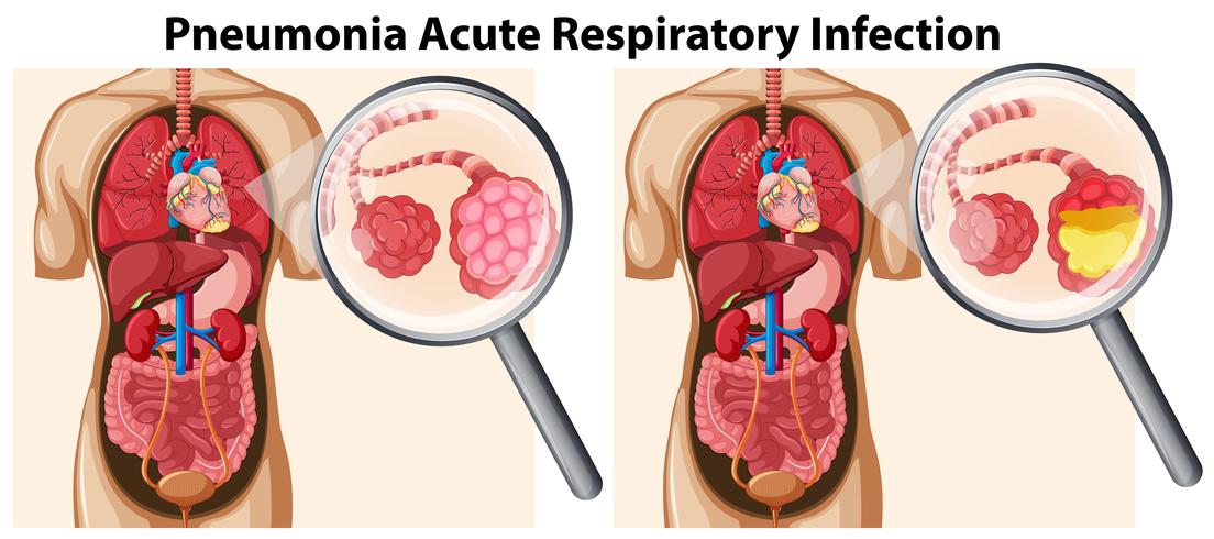 Infección respiratoria aguda neumonía vector