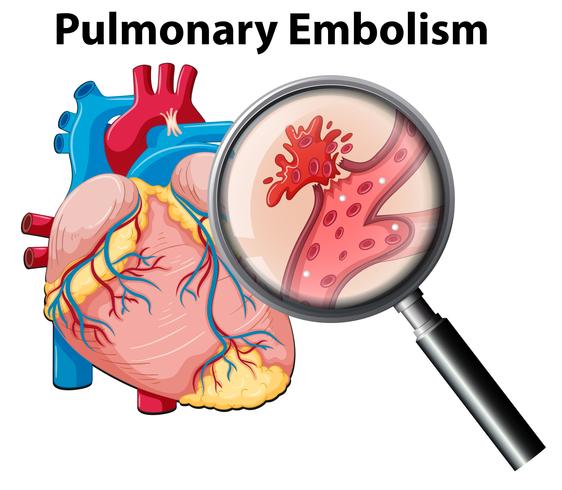 Embolia pulmonar anutomia humana vector