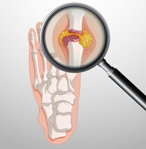 Human feet with gout vector