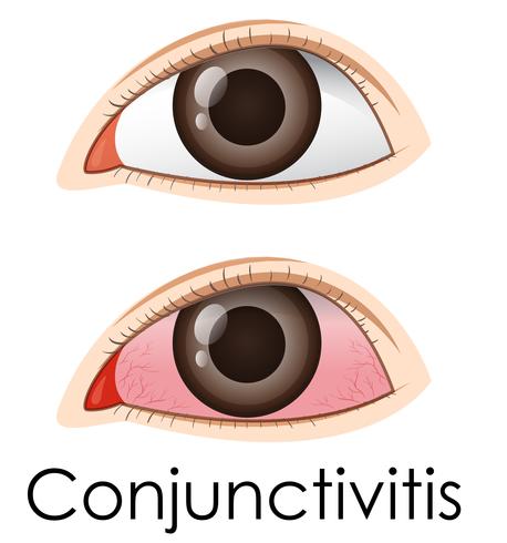 Conjuntivitis en ojos humanos. vector