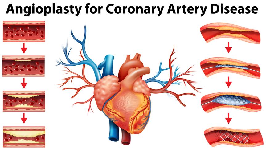 Diagram showing angioplasty for coronary artery disease vector