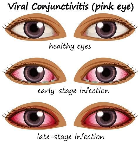 Viral conjuctivitis in human eyes vector