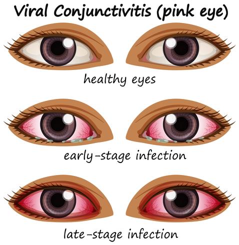 Conjuntivitis viral en ojos humanos vector