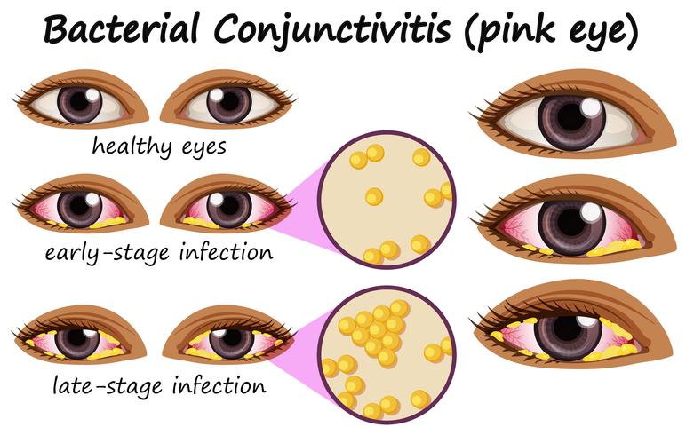 Diagram showing bacterial conjunctivitis in human eye vector